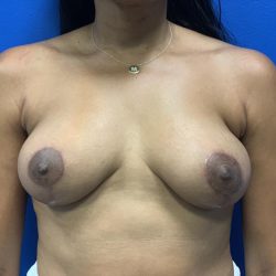 Breast Lift Before & After Patient #4739
