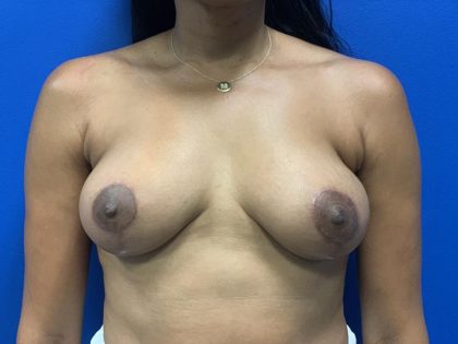 Breast Lift Before & After Patient #4739