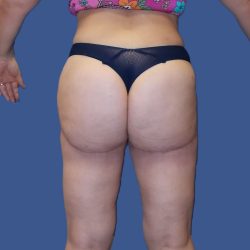 Thigh Lift Before & After Patient #4840