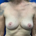 Breast Explant Before & After Patient #4799