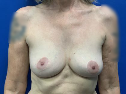 Breast Explant Before & After Patient #4799