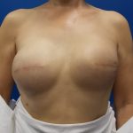 Tissue Expander To Implant Breast Reconstruction Before & After Patient #4876