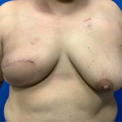 Latissimus Flap Breast Reconstruction Before & After Patient #4911