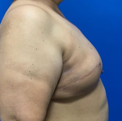 Latissimus Flap Breast Reconstruction Before & After Patient #4911