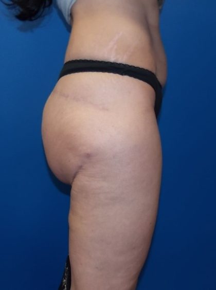 Body Contouring Before & After Patient #4810