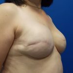 Tissue Expander To Implant Breast Reconstruction Before & After Patient #4883