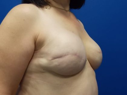 Tissue Expander To Implant Breast Reconstruction Before & After Patient #4883