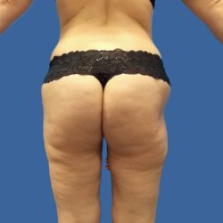Thigh Lift Before & After Patient #4840