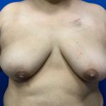 Latissimus Flap Breast Reconstruction Before & After Patient #4911