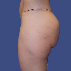 Thigh Lift Before & After Patient #4810