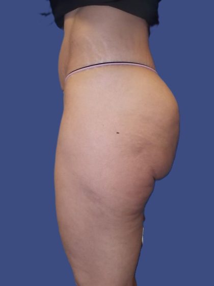 Body Contouring Before & After Patient #4810