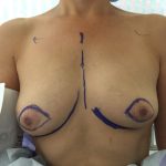 Tissue Expander To Implant Breast Reconstruction Before & After Patient #4876