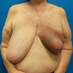 Latissimus Flap Breast Reconstruction Before & After Patient #4914