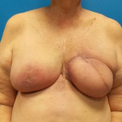 Latissimus Flap Breast Reconstruction Before & After Patient #4914