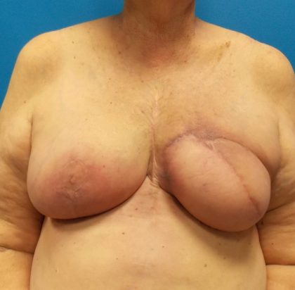 Latissimus Flap Breast Reconstruction Before & After Patient #4914