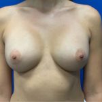 Breast Augmentation Before & After Patient #4761