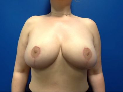 Breast Reduction Before & After Patient #4833