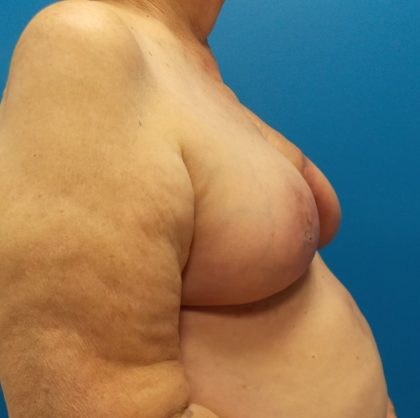 Latissimus Flap Breast Reconstruction Before & After Patient #4914