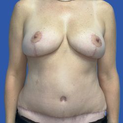 Mommy Makeover Before & After Patient #4953