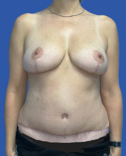 Mommy Makeover Before & After Patient #4953