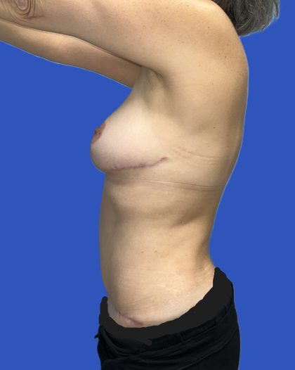 Mommy Makeover Before & After Patient #4953
