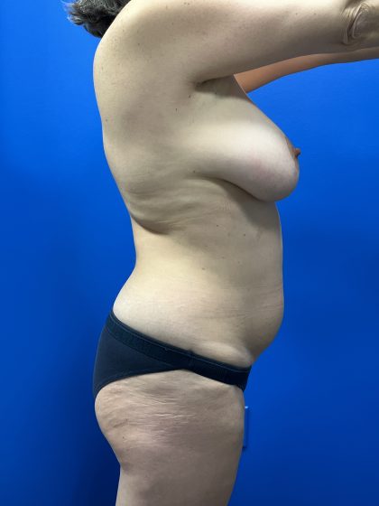 Mommy Makeover Before & After Patient #4953