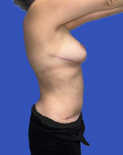 Mommy Makeover Before & After Patient #4953