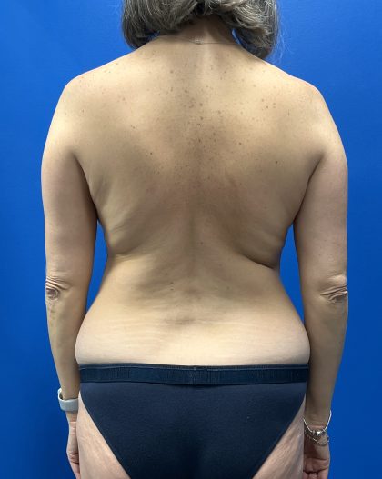 Mommy Makeover Before & After Patient #4953