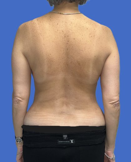 Mommy Makeover Before & After Patient #4953