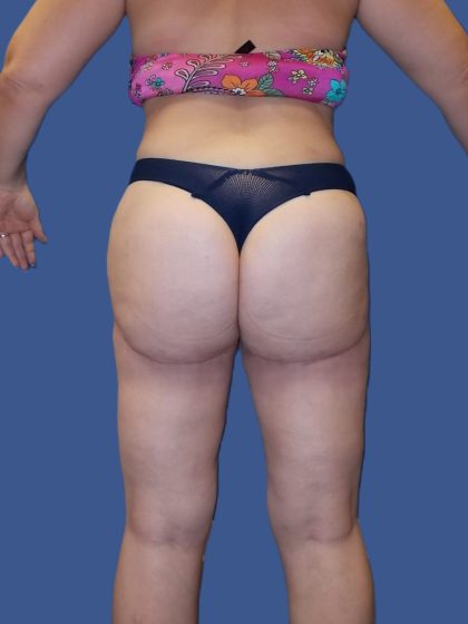 Thigh Lift Before & After Patient #4989