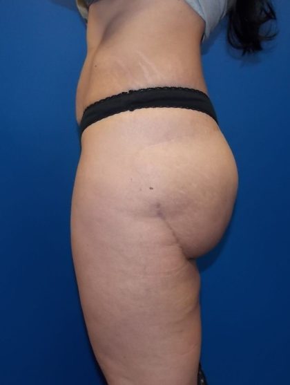 Thigh Lift Before & After Patient #5003
