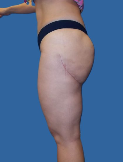 Thigh Lift Before & After Patient #4989