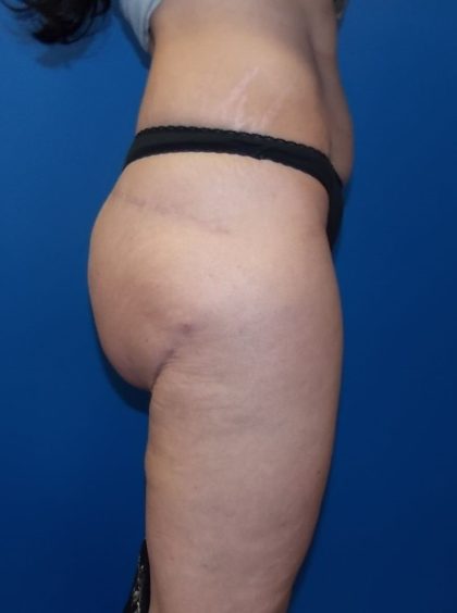 Thigh Lift Before & After Patient #5003