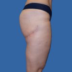 Thigh Lift Before & After Patient #4989