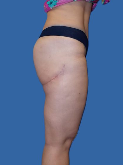 Thigh Lift Before & After Patient #4989