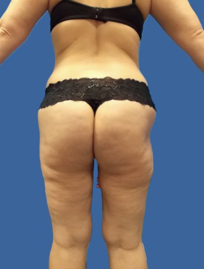 Thigh Lift Before & After Patient #4989