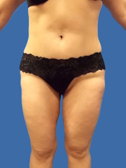 Thigh Lift Before & After Patient #4989