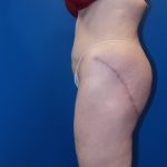 Thigh Lift Before & After Patient #5009