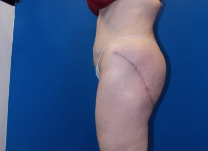 Thigh Lift Before & After Patient #5009