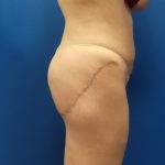 Thigh Lift Before & After Patient #5009