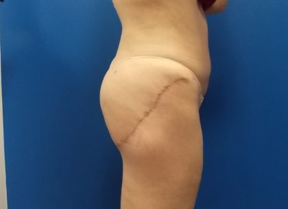 Thigh Lift Before & After Patient #5009