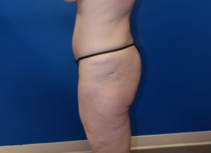Thigh Lift Before & After Patient #5009