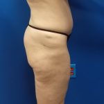 Thigh Lift Before & After Patient #5009