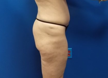 Thigh Lift Before & After Patient #5009