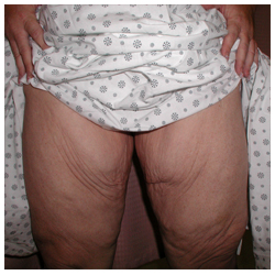 Thigh Lift Before & After Patient #5019