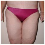 Thigh Lift Before & After Patient #5019