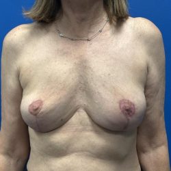 Breast Explant Before & After Patient #4969