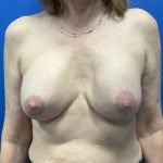 Breast Explant Before & After Patient #4969