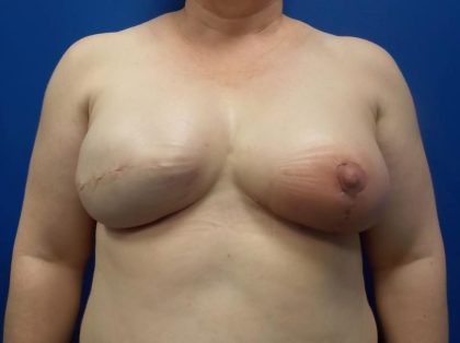 Tissue Expander To Implant Breast Reconstruction Before & After Patient #4938