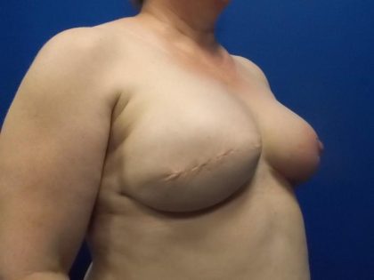 Tissue Expander To Implant Breast Reconstruction Before & After Patient #4938